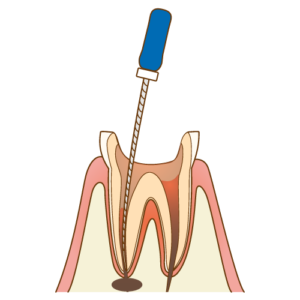 神経を抜いた歯でも痛くなる！？その原因は？
