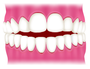 あなたが気になる歯の並びはどのようなものでしょうか？