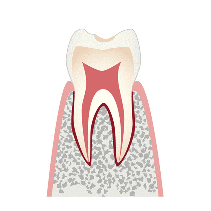 C0（初期の虫歯）