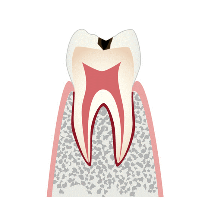 C1（エナメル質までの虫歯）