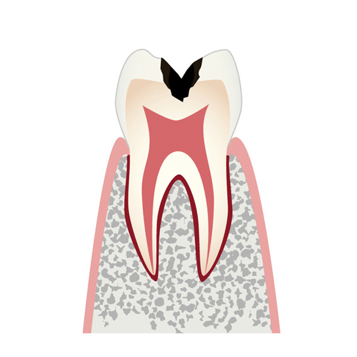 C2（象牙質にまで達した虫歯）