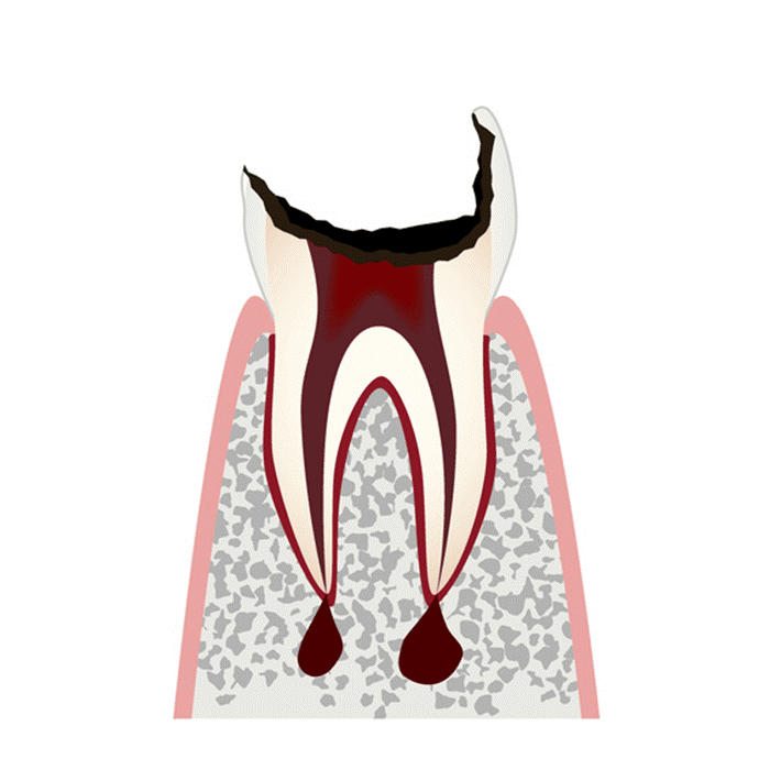 C4（歯のほとんどが虫歯で失われた状態）
