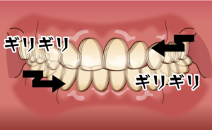 歯ぎしり