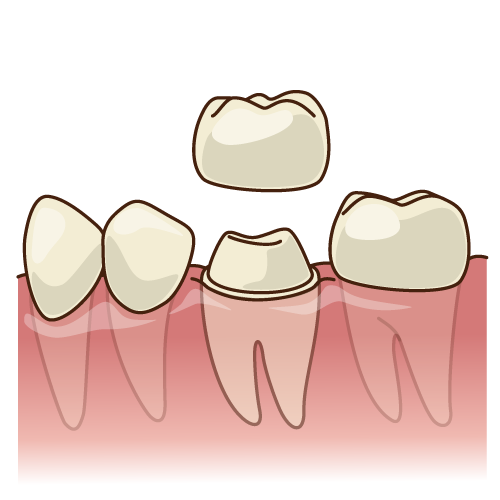 白い被せ（クラウン）を入れる