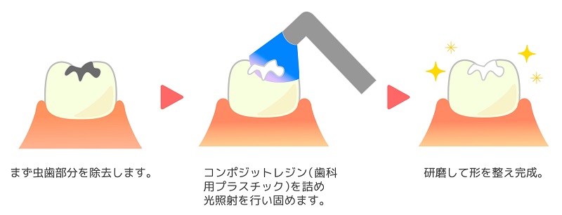 「レジン」というプラスチックでコーティングをする