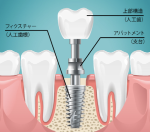 インプラントの構造