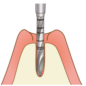 インプラントを入れる穴を開けていきます