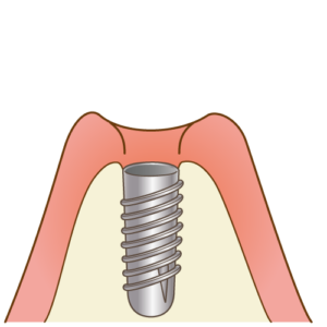 インプラントを入れます