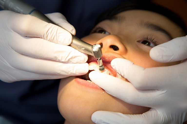 歯のクリーニング（PMTC）