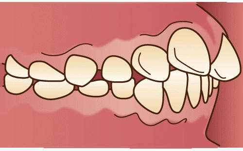 上顎前突（じょうがくぜんとつ）