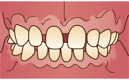 空隙歯列（くうげきしれつ）