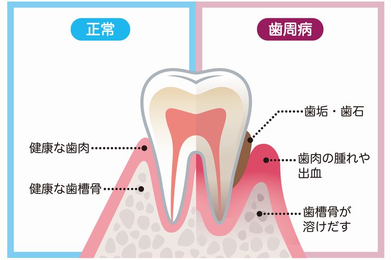 歯周病とは