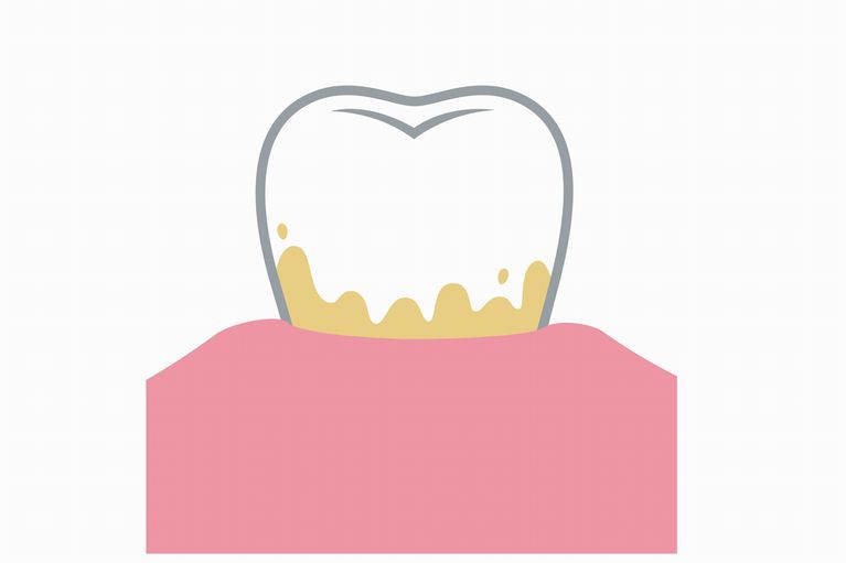 歯周病の原因