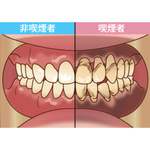 タバコを吸うと歯周病になりやすい？