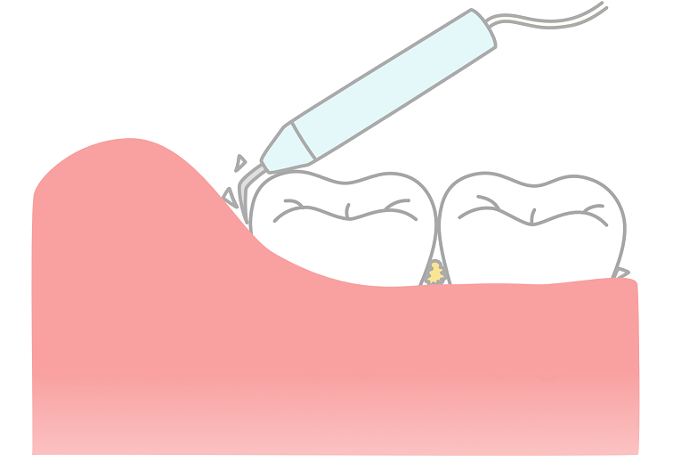 歯石取り（歯石除去）について