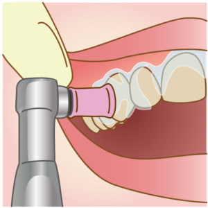 まずは歯の表面のクリーニングを行います