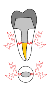歯の根っこが割れる歯根破折とは？