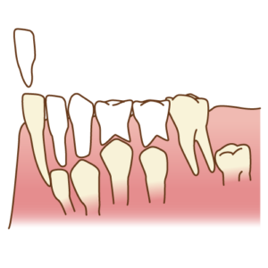 子供の乳歯がグラグラして抜けない 対処法 大阪府茨木市 新井歯科
