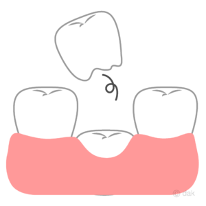 子供の乳歯がグラグラして抜けない 対処法 大阪府茨木市 新井歯科