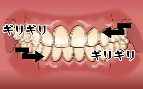 力のコントロールの大切さ〜お口のトラブルを減らすために〜