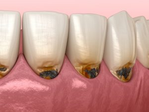 根っこの表面（根面）はやわらかく、虫歯になりやすい