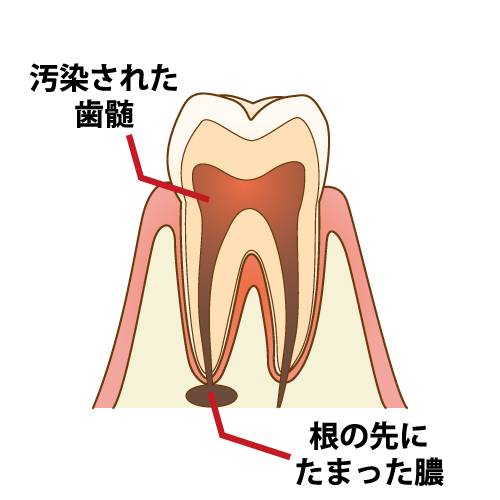 根尖性歯周炎とは
