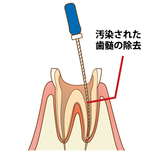 根尖性歯周炎の治療法