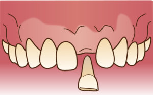 歯を抜いて放置したままだと。。。