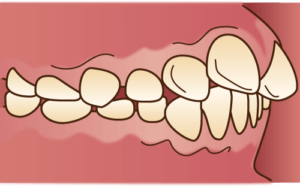 昔より前歯が出てきたと感じる方へ