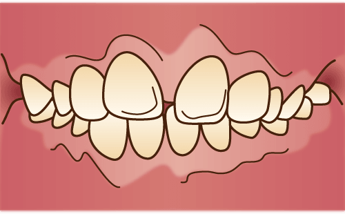 前歯の隙間（すきっ歯）が気になる方へ