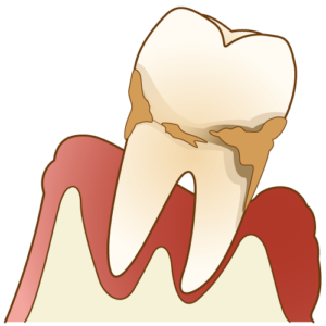 歯周病の進行
