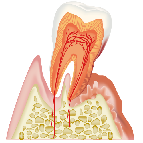 歯周病と全身への影響