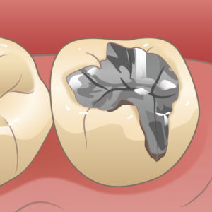 むし歯が再発する原因と予防法