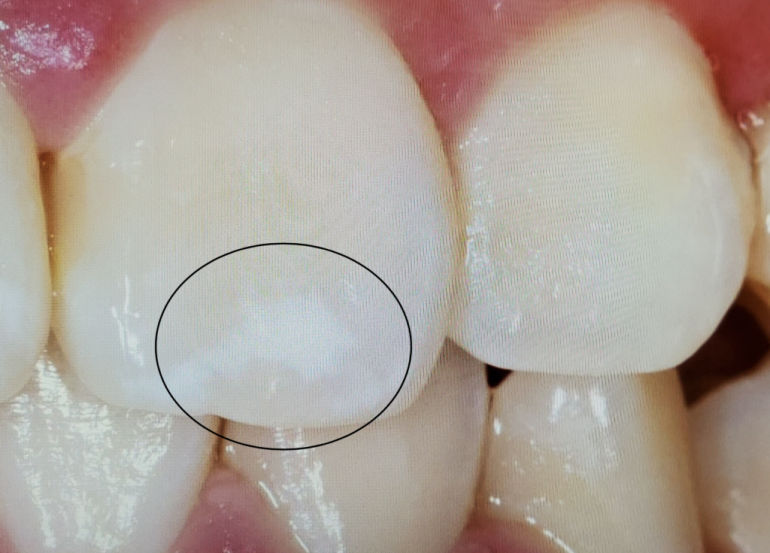 歯の表面の白い斑点が気になる方へ