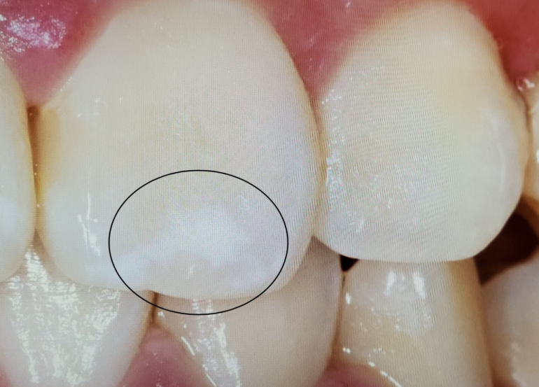 歯の表面の白い斑点が気になる方へ 新井歯科