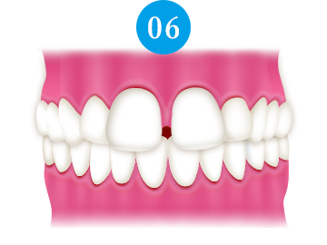 空隙歯列（すきっ歯）